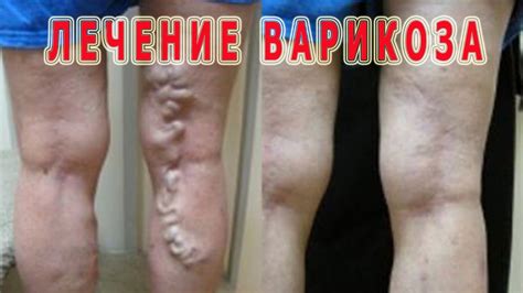Лечение варикоза в Красноярске - отзывы и рекомендации